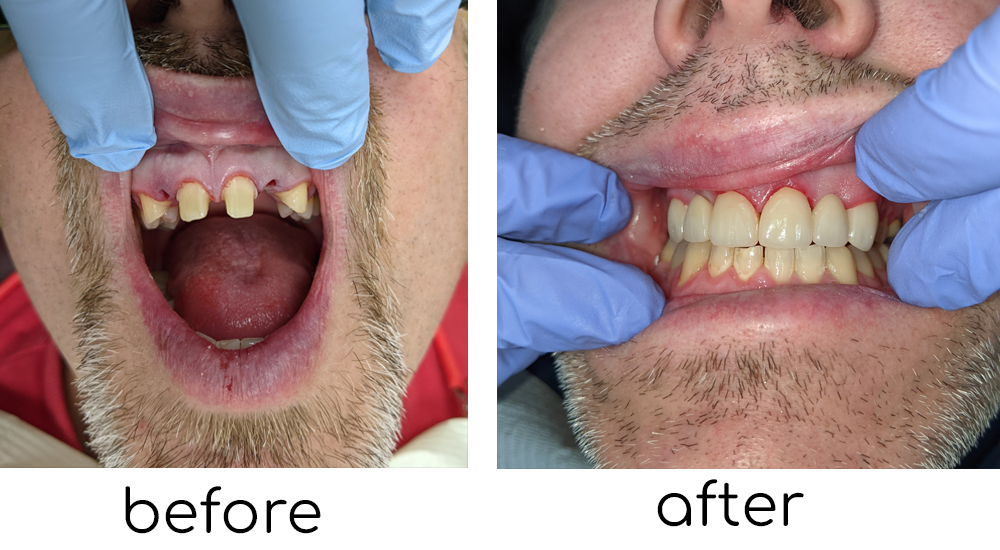 Dental Bridge - Mouth Restoration Saskatoon