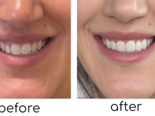 Saskatoon Procelain Veneers