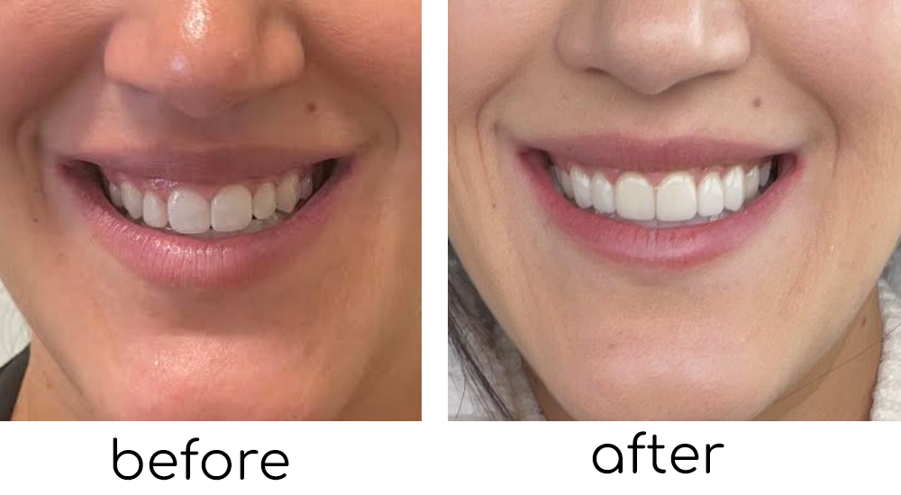 Saskatoon Procelain Veneers